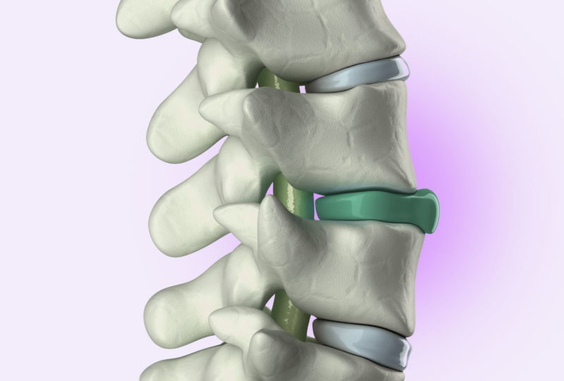 Bandscheibenproblem: Warum ist die Matratze wichtig?